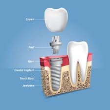 Dental Implant Procedures in Delhi